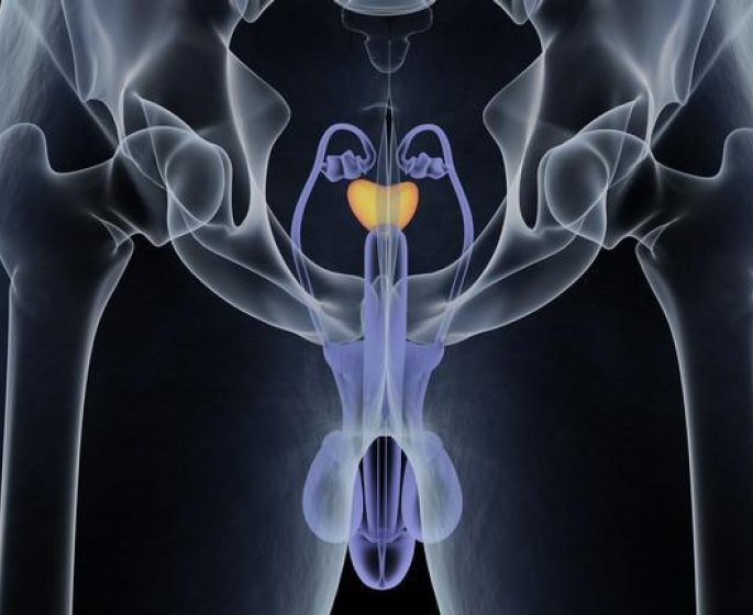 Cancer de la prostate : les signes d-alerte des metastases