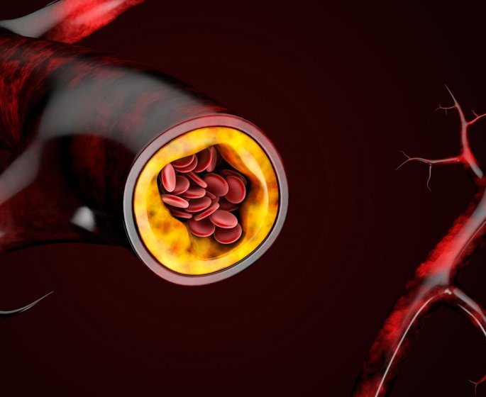 Quels sont les signes d-une atherosclerose ?