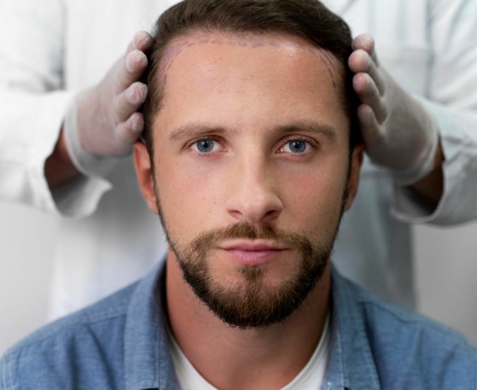 Perte de cheveux : les motivations derriere le choix des implants capillaires