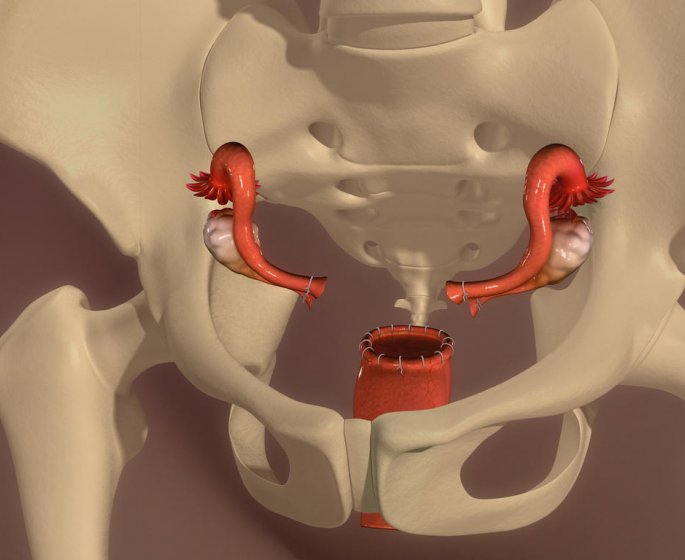 Ablation de l-uterus : l-hysterectomie, une methode de sterilisation feminine ?