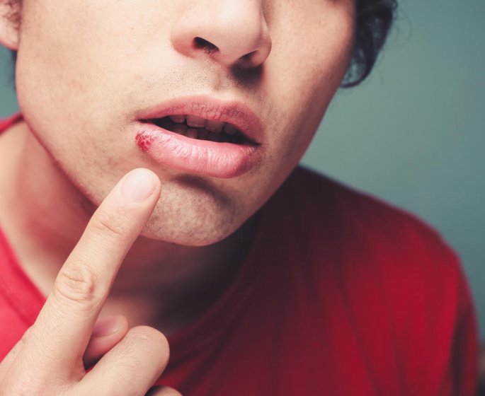 Herpes : prevenir le bouton de fievre, c-est possible !