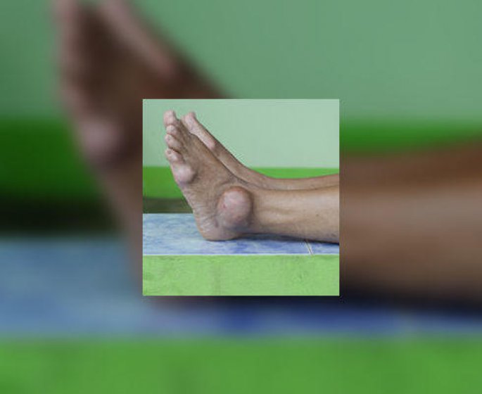 Crise de goutte : quels symptomes, quelles causes ?