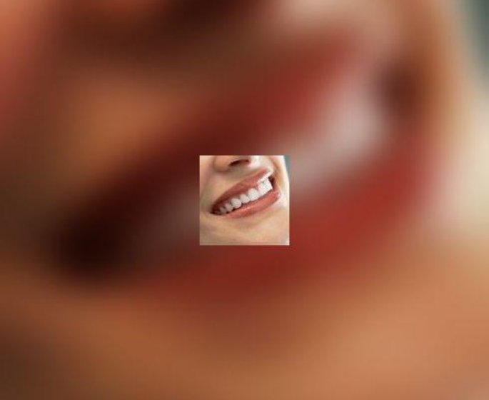 Blanchiment des dents : quels risques ?