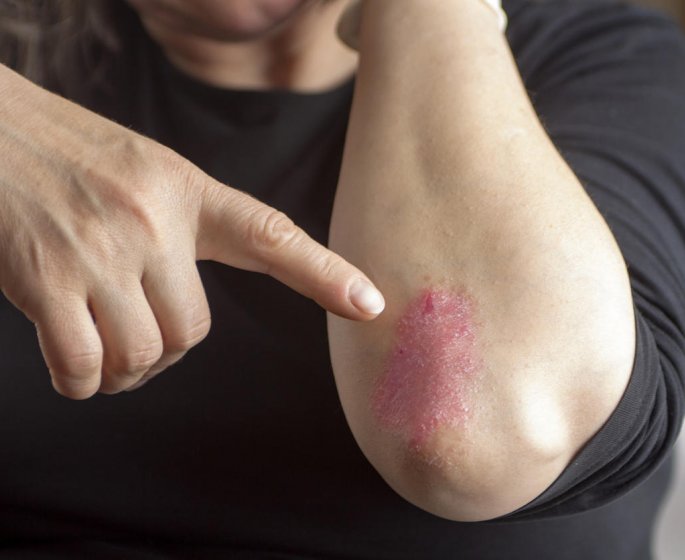 Psoriasis des solutions existent