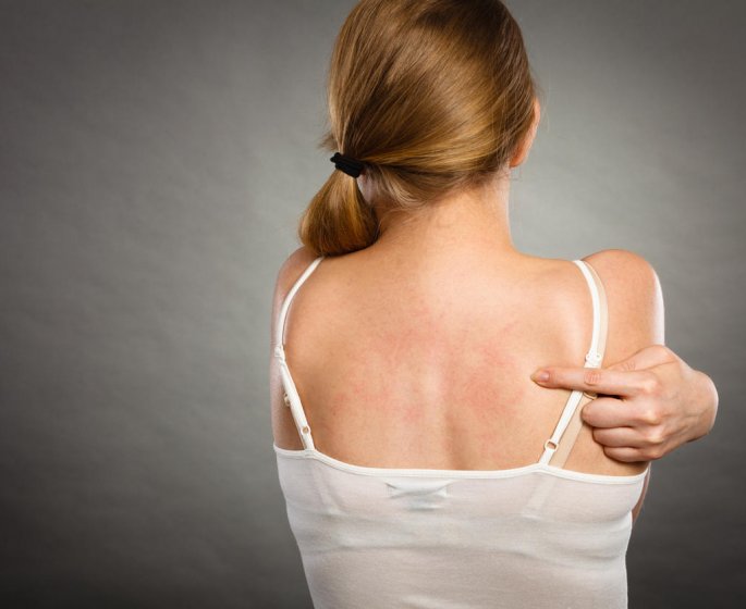 L-urticaire, c-est quoi exactement ?