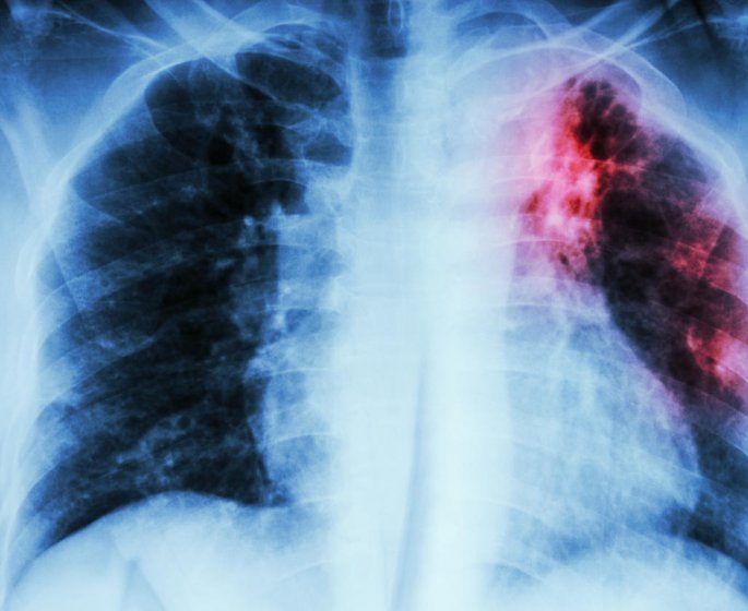 Tuberculose : 7 signes qui doivent alerter 