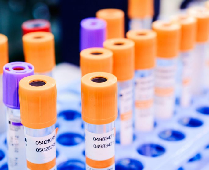 Ferritine : les taux a ne pas depasser