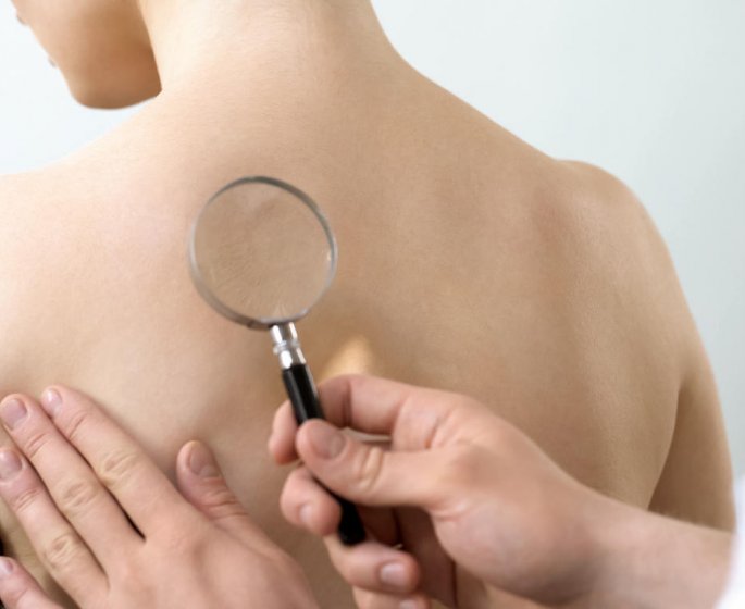 Urticaire geante : comment la reconnaitre ?