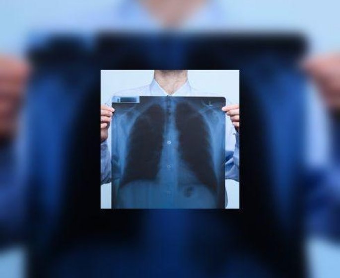 Aspergillose : attaque fongique des poumons