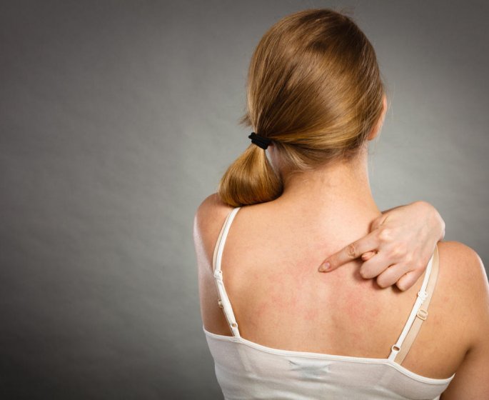 Urticaire : et si c’etait le stress ?