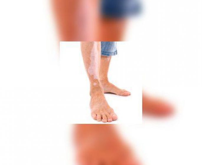 Vitiligo : quand la peau perd sa couleur