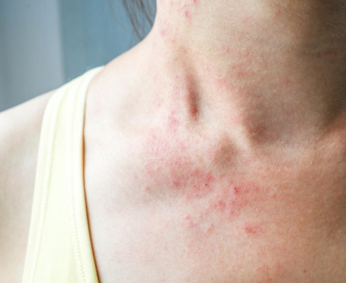 Eczema allergique : les symptomes