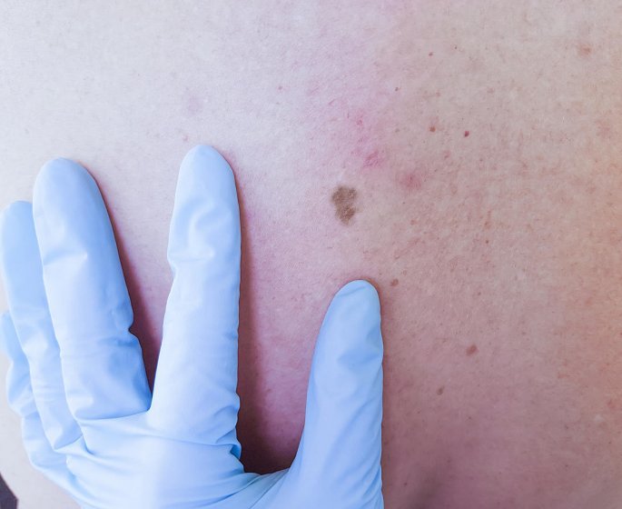 Cancer de la peau : le carcinome epidermoide