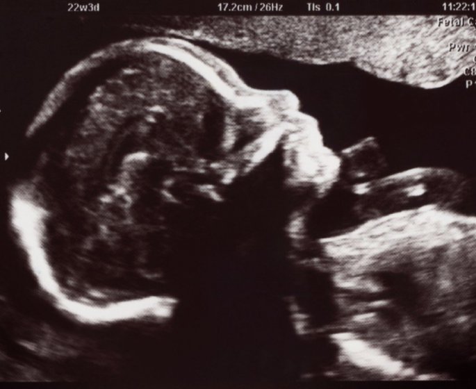 Atteinte de la maladie des os de verre, elle arrive a avoir un bebe