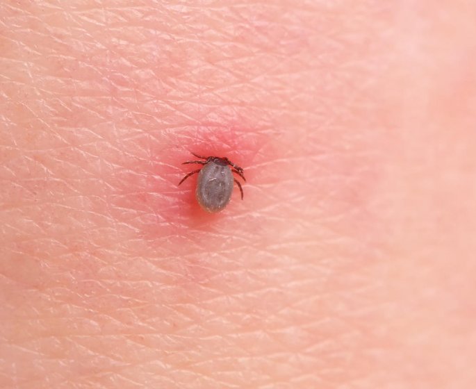 Maladie de Lyme : que faire en cas de morsure de tique ?