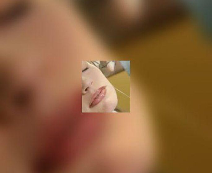 Rajeunissement du visage : apres le lifting, les fils de suspension