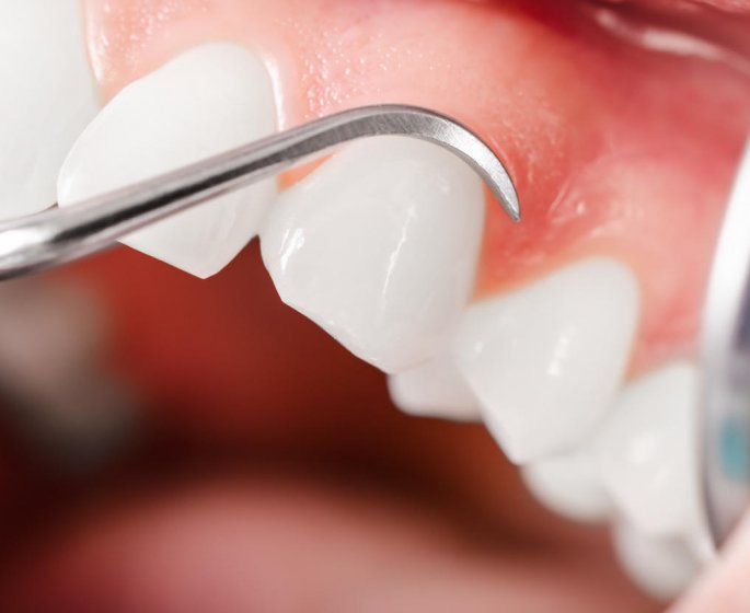 Gencive blanche : les traitements contre les abces