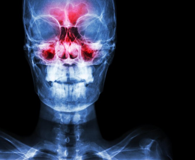Les medecins lui diagnostiquent une infection des sinus, elle finit paralysee