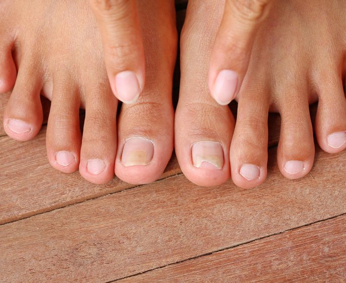 Ongle ecrase ou arrache, comment reagir ?