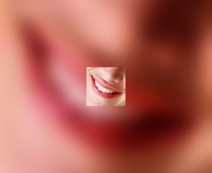Contre les taches sur les dents : le blanchiment