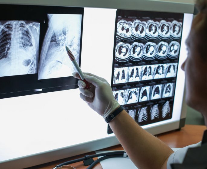 Cancer du poumon : qu-est-ce qu-un nodule pulmonaire ?