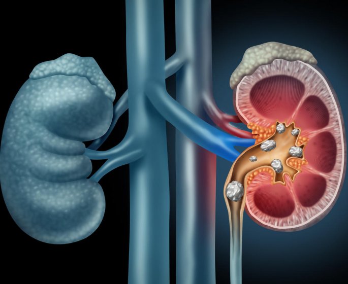 Pourquoi les calculs biliaires, renaux, urinaires et lithiases sont-ils en augmentation ?