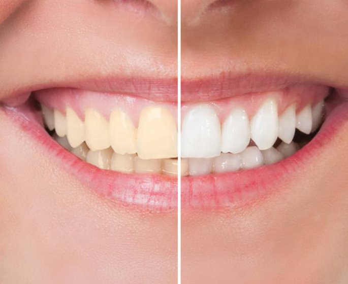 Comment obtenir des dents plus blanches en quelques minutes par jour ?