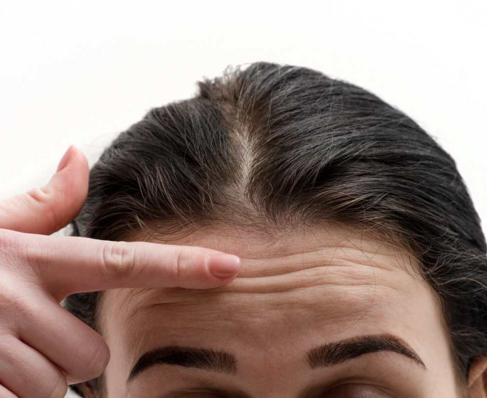 Comment se forment les boutons d-acne ?