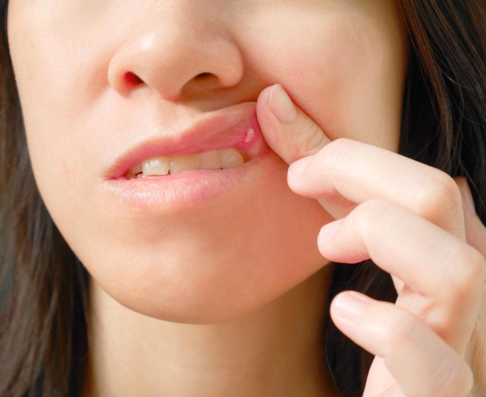 Pourquoi certains aliments donnent des aphtes ?