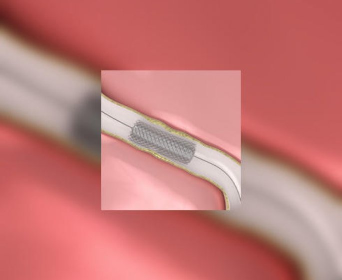 Angioplastie, stent : comment sauvent-ils nos arteres ?