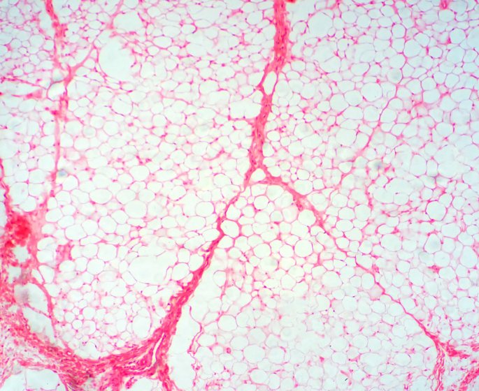 Diabete : chaque kilo de graisse viscerale en plus multiple vos risques par 7