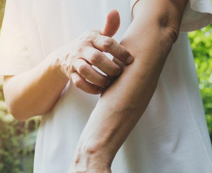 Attention a l-allergie aux moustiques