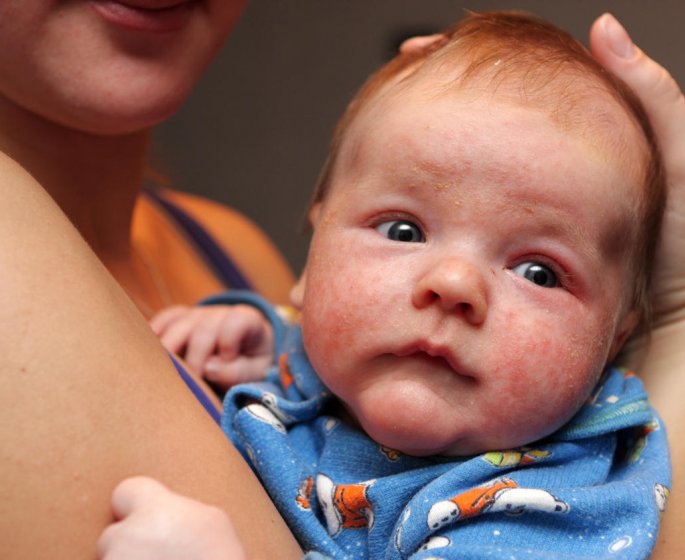 Bebe : eczema, dermatite atopique, quels symptomes, quels traitements ?