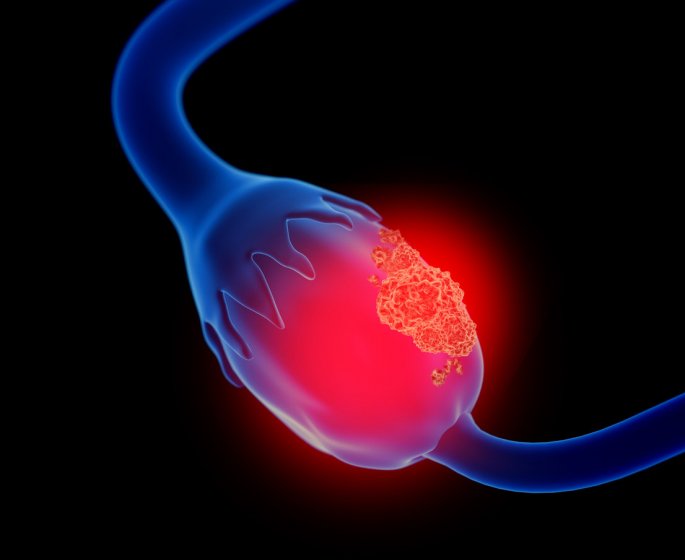 Kyste aux ovaires : quels symptomes doivent alerter ?