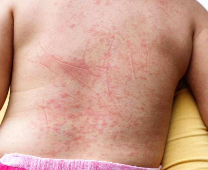 Purpura : taches rouges sur la peau, que se passe-t-il ?