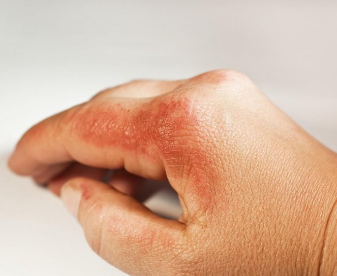 11 trucs a savoir en cas de brulure