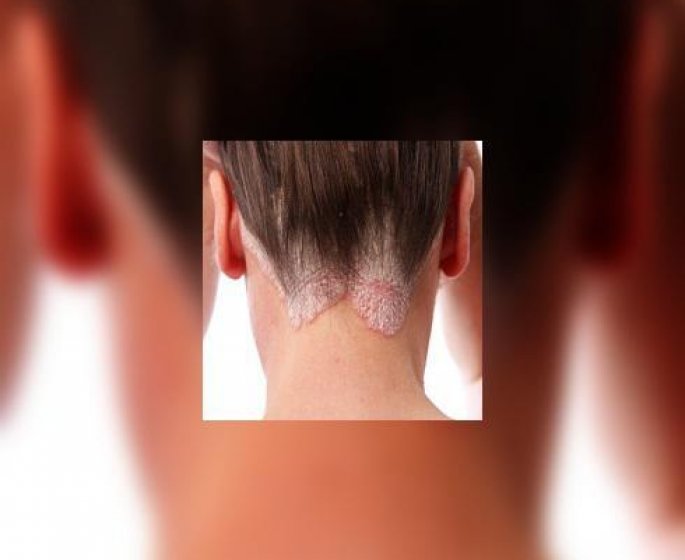 Psoriasis, et si on en parlait ?