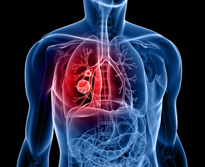 Ses mains “veloutees” etaient le signe d’un cancer du poumon