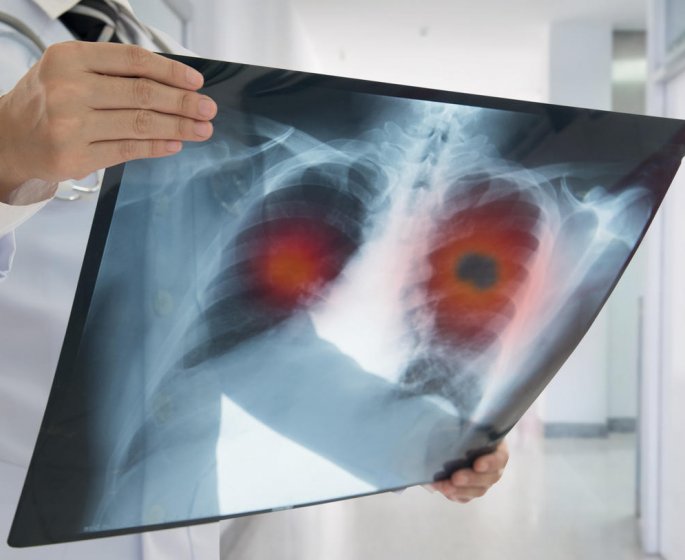 Les principaux symptomes du cancer du poumon