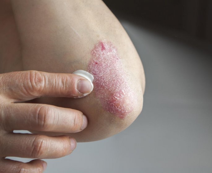 Psoriasis : 5 solutions naturelles