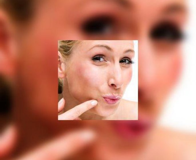 Gare a une aggravation de l-acne apres une exposition au soleil