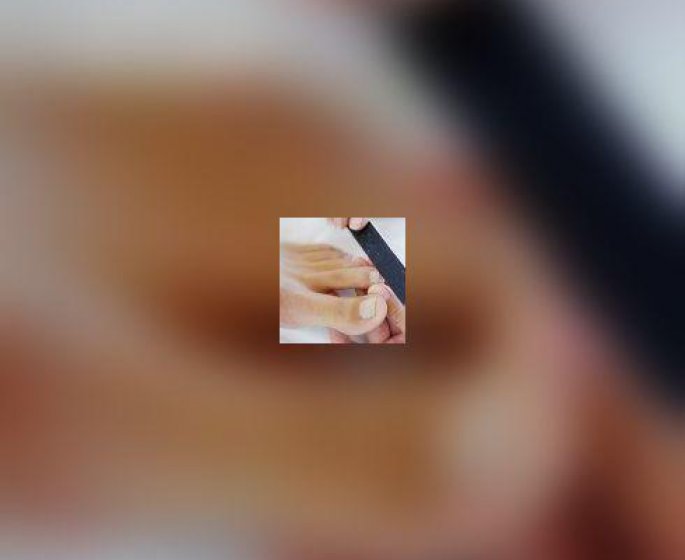 Mycoses et onychomycoses : autosurveillance
