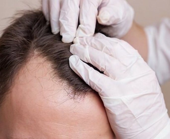 Greffe de cheveux en Turquie et en France : les prix et meilleures cliniques 