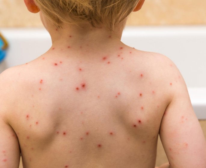 Boutons rouges : comment savoir si c-est une maladie infantile ?