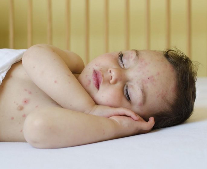 Epidemie de varicelle : les bons reflexes a avoir
