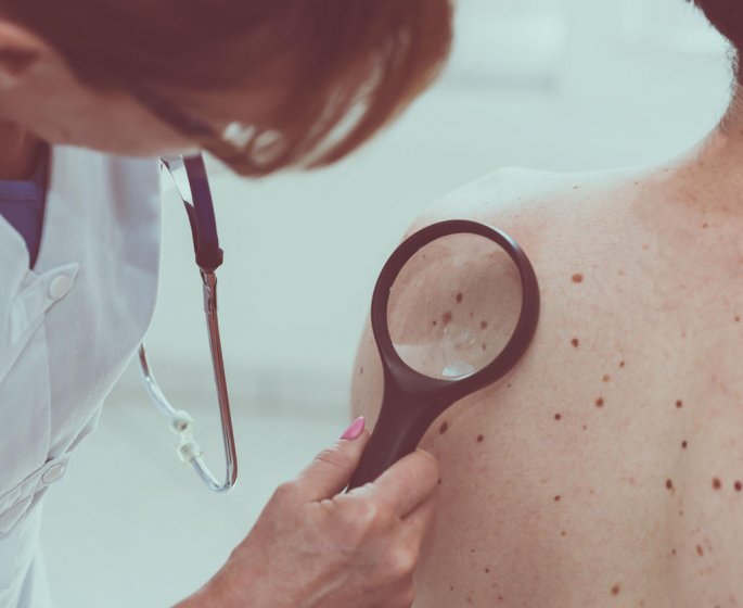 Cancer de la peau : les carcinomes basocellulaires et spinocellulaires