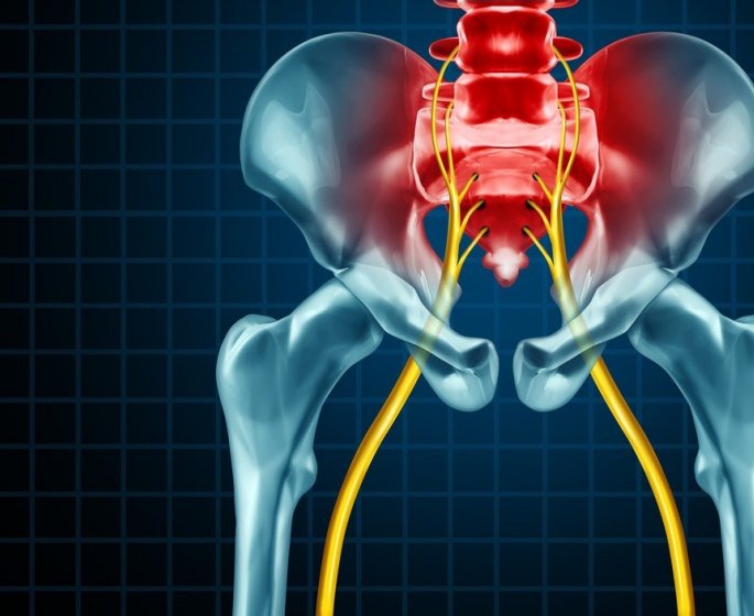 Comment reconnaitre une sciatique ?