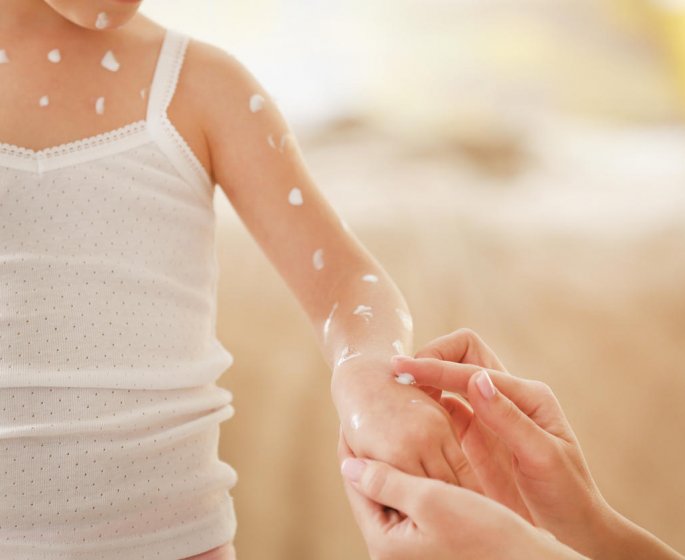 Enfant et varicelle : tout savoir