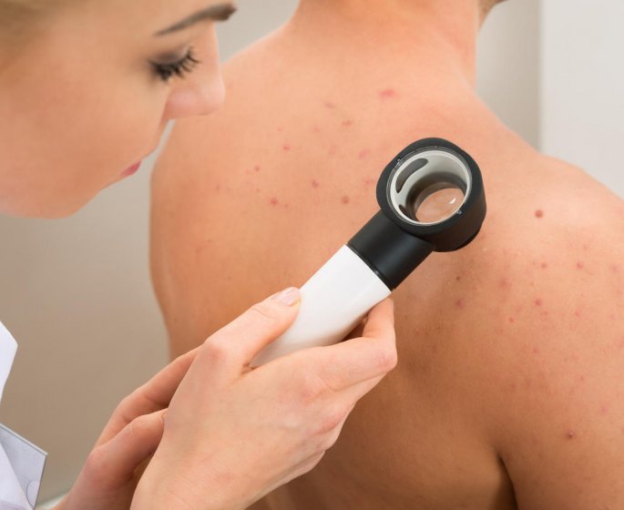 Acne : les causes qu-on ignore trop souvent