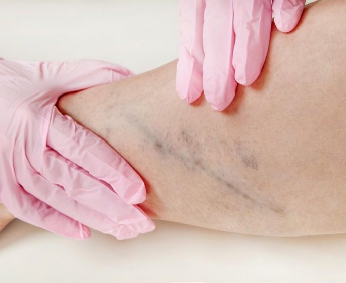 Operation des varices : quand, comment, pourquoi ?